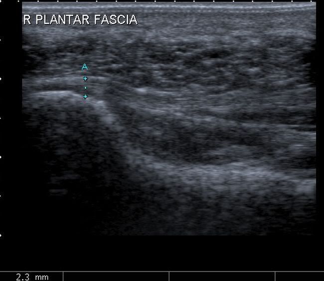 Plantar Fascitis