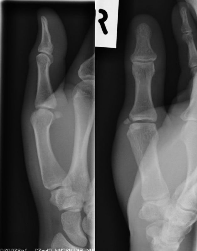 Fracture In Hand