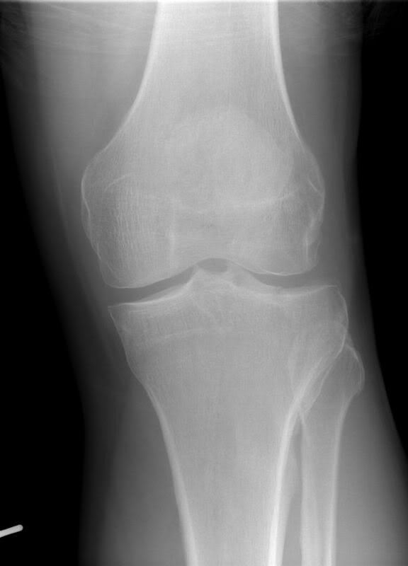Tibial plateau fracture