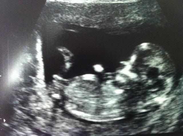 12 Week Gender Ultrasound Guesses Please! Nub/Angle of the Dangle