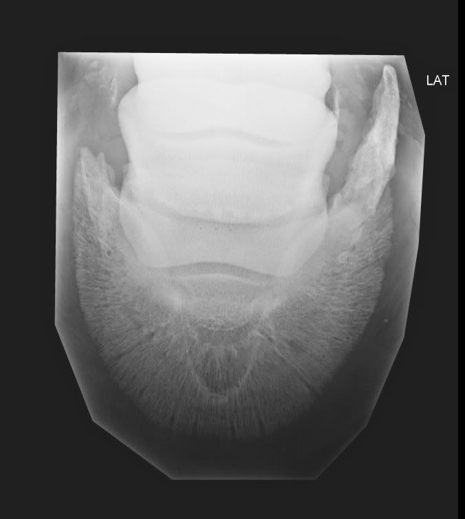 Pedal bone fractureany experience?