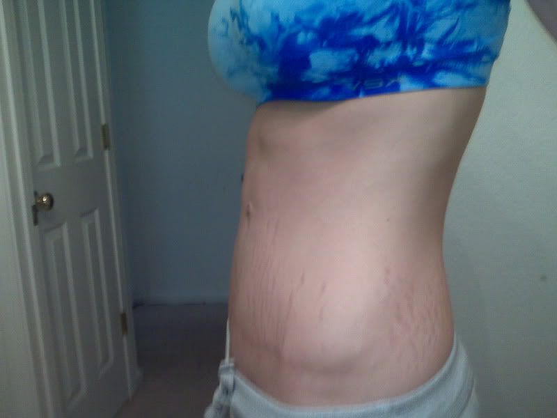 before and after tummy tuck scars